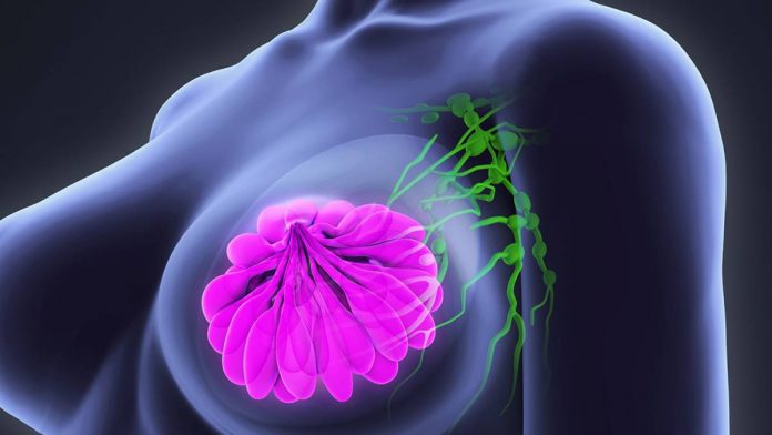 mitos y verdades sobre el cáncer de mama